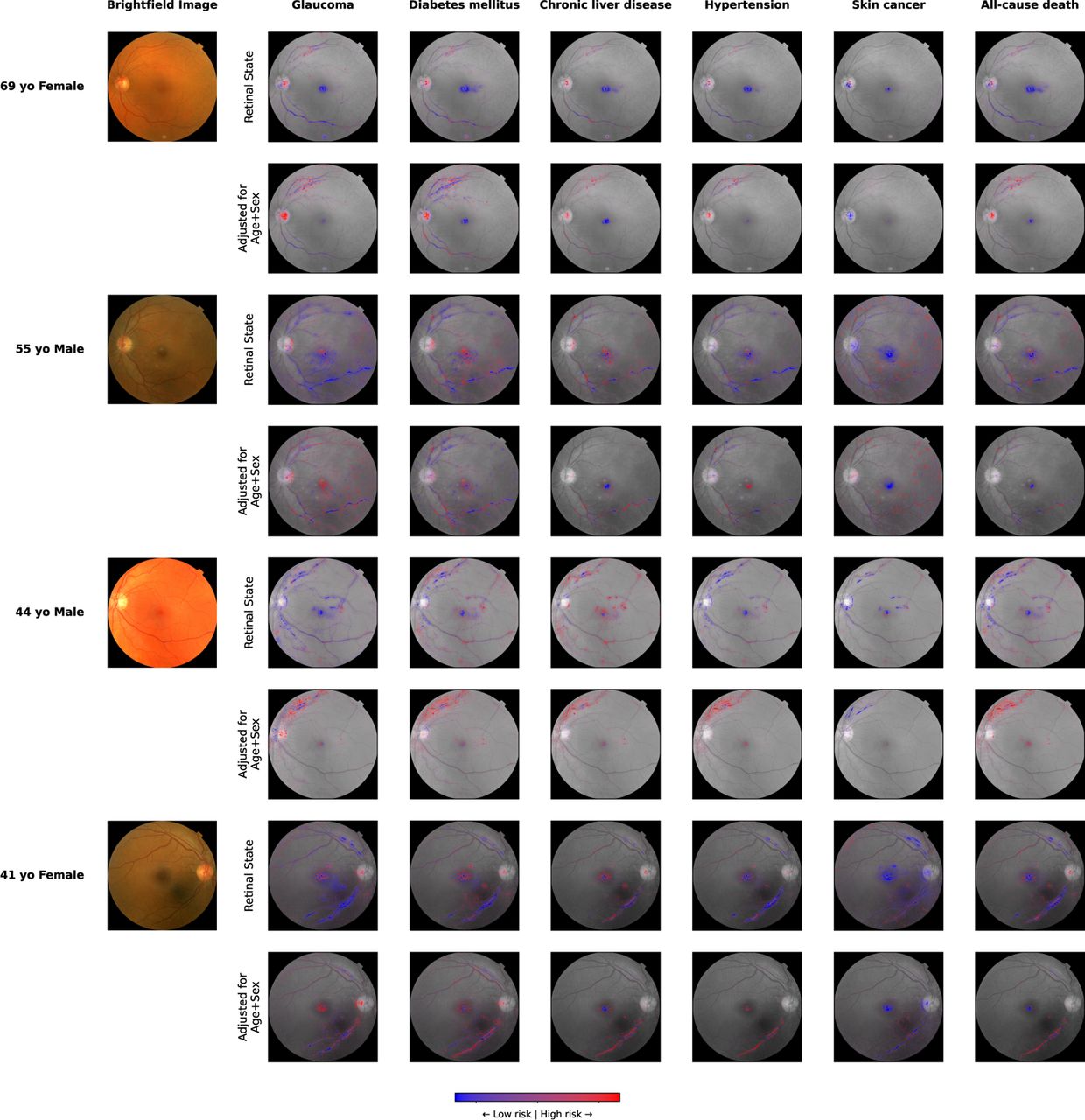 Comparison of adjusted and unadjusted attributions Image attributions for five selected endpoints and four individuals were derived via information bottleneck attribution (IBA) against the retinal state (top row) and the retinal state adjusted by age and biological sex (bottom row). Regions with attributions to increased risk are highlighted in red, while regions with attribution to decreased risk are highlighted in blue. The colour intensity corresponds to the strength of attribution.