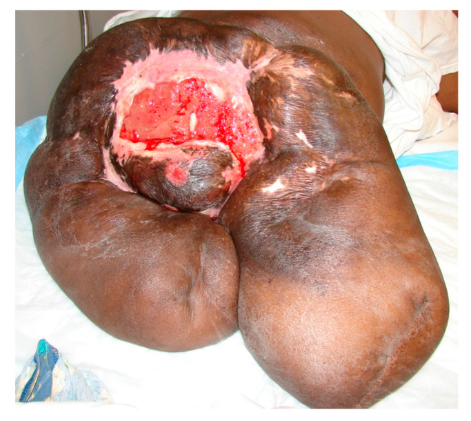 A complex chronic sacral, perineal wound in a paraplegic patient who already underwent hip disarticulation on the left side and above-the-knee amputation on the right side due to recalcitrant pressure ulcers. This wound eventually became Marjolijn’s ulcer with a malignant transformation into a highly aggressive squamous carcinoma.