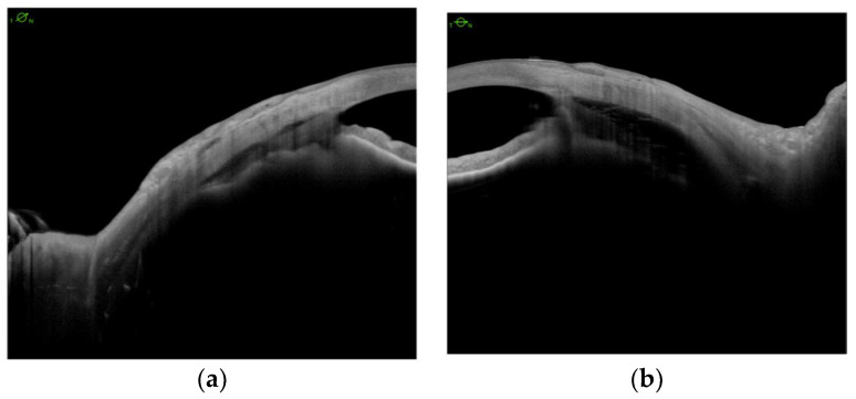Anterior segment swept-source OCT demonstrates ciliary body detachment preoperatively (a,b) and postoperatively (c,d).