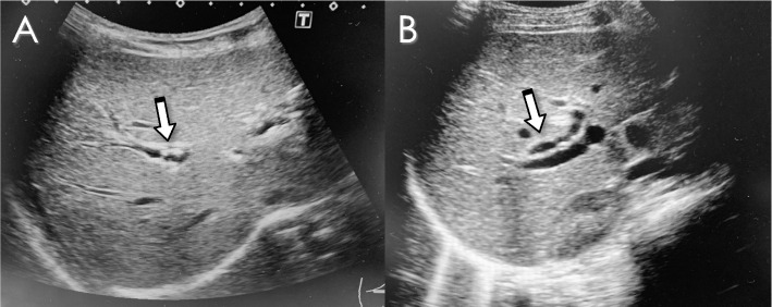 Ultrasound findings in a case in which an IHBD stone disappeared with oral UDCA. A Before treatment. Arrow indicates an IHBD stone in the right hepatic duct. B After treatment. Arrow shows the absence of the stone