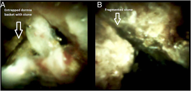 (A) Cholangioscope image showing wires of the entrapped Dormia basket. (B) Cholangioscope image showing the fragmented stone.