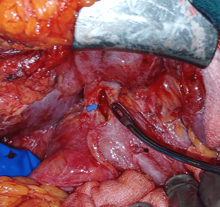 Anastomotic stricture of a previous Roux-en-Y hepaticojejunostomy opened longitudinally.Blue arrow: stricture site in the common hepatic duct that has been longitudinally incised