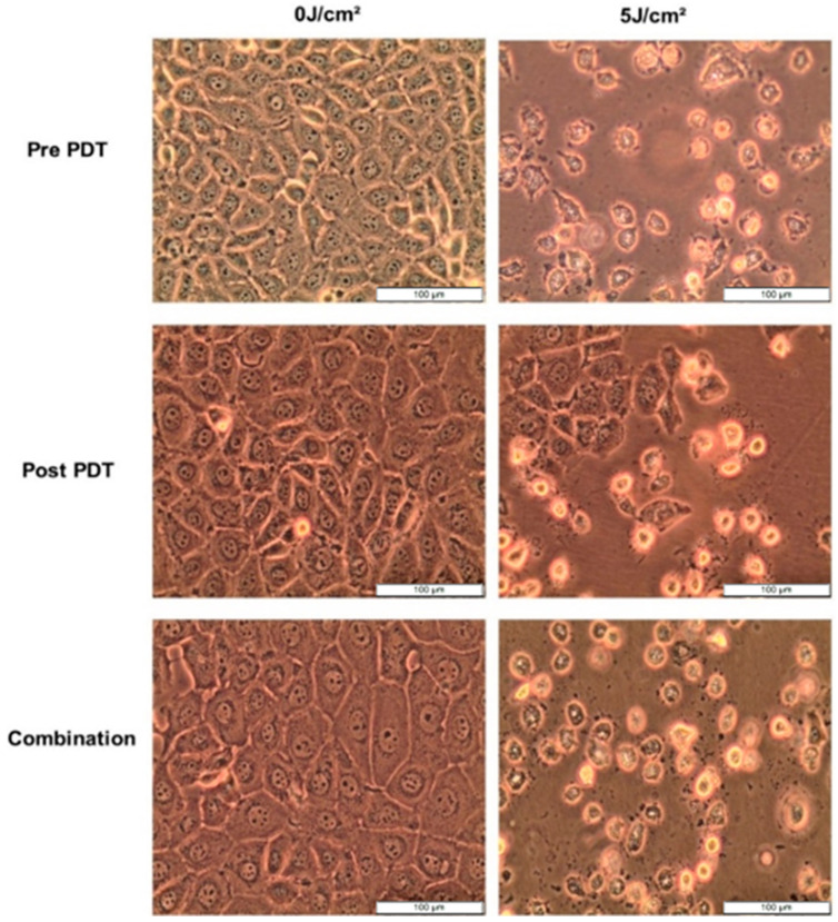 Cellular morphology of MCF-7 cells observed at 100× magnification prior to PDT, 12 h after CBD, Hypericin-AuNP PDT and in conjunction with Combination Therapy.