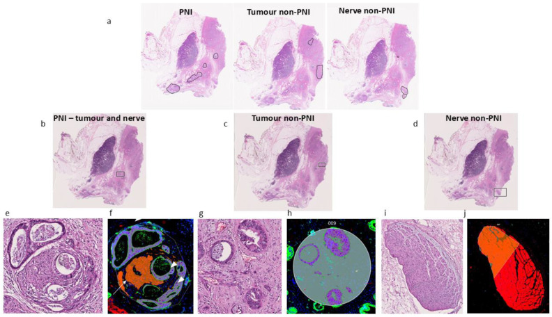Representative images of regions collected in this study. (a) H&E image of sample used in this study with circled regions containing PNI and cancer or nerves (non-PNI). (b–d) Black squares in specimen indicate regions selected for GeoMx. (e) Zoomed image of region selected in H&E in (b) (PNI region). (f) Same region presented in (e), showing GeoMx DSP ROI and segmented AOIs in terms of PanCK and PGP9.5 positivity for collection of tags. Cancer (arrowhead) and nerve (arrow) compartments in PNI focus. (g) H&E of cancer compartment (non-PNI) indicated in (c) (square), cancer away from any visible nerve. (h) GeoMx DSP ROI showing segmented AOI in terms of PanCK positivity (purple) for collection of tags. (i) H&E image of uninvolved nerve (non-PNI) away from tumor microenvironment indicated in (d) (square), with no visible cancer invasion. (j) GeoMx DSP of collected ROI. Regions (e–j) are examples of regions where gene expression was measured; selection of regions was based on visual inspection of adjacent H&E and PanCK or PGP9.5 positivity for collection of expression tags.