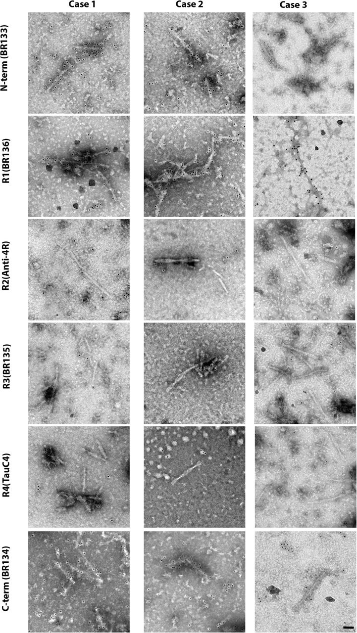 Immunolabelling of tau filaments extracted from the frontal cortex of CBD cases 1-3.Representative immunogold negative-stain electron microscopy images of Type I and Type II tau filaments labelled with antibodies BR133, BR136 and BR134. Antibodies Anti-4R, BR135 and TauC4 did not label filaments, which indicates that their epitopes lie within the ordered filament cores. Scale bar, 50 nm.