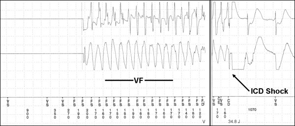Stored electrogram from the ICD. Ventricular fibrillation followed by a successful ICD shock.
