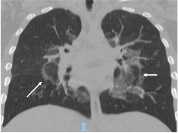 Chest CT (coronal view) showing the “atoll sign” or “reversed halo sign” bilaterally (arrrows)