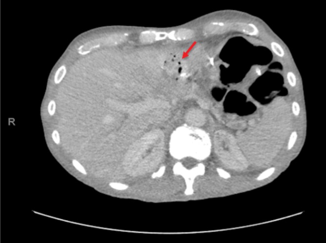 CT scan showing 7-cm collection with fluid and air (arrow) adjacent to the DJ and PJ. DJ, duodenojejunostomy; PJ, pancreatojejunostomy.