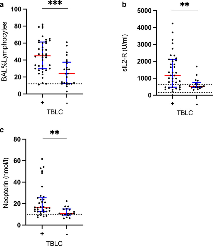 BAL and serological parameters and diagnostic success of TBLC. (a) Patients with positive TBLC (+) patients exhibit higher percentage of BAL lymphocytes compared with patients with non-diagnostic TBLC (−). (b) Patients with positive TBLC (+) have higher serological sIL2R values compared with patients with non-diagnostic TBLC (−). (c) Patients with positive TBLC (+) have higher serological neopterin values compared with patients with non-diagnostic TBLC (–). Values and p values: see online supplemental table S4. BAL, bronchoalveolar lavage; sIL2-R, soluble interleukin 2 receptor; TBLC, transbronchial lung cryobiopsy.*** p<0.001; ** p<0.01.