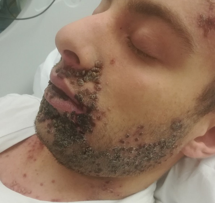 Vesico‐pustular eruption involving face