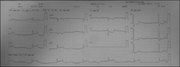 ST elevation in inferior leads on 12-derivation ECG obtained in the emergency department
