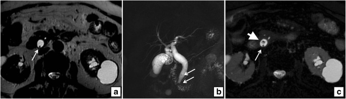 a Axial T2-weighted MRI shows a millimetric filling defect in a dilated CBD (arrow). b Coronal MIP reformat of the same patient shows multiple filling defects in the gallbladder and two stones are seen in the distal CBD (arrows) with mild upstream dilatation. c Axial fat-saturated T2-weighted MRI of the same patient shows two filling defects in a dilated CBD (arrow and arrowhead) at the same level of a
