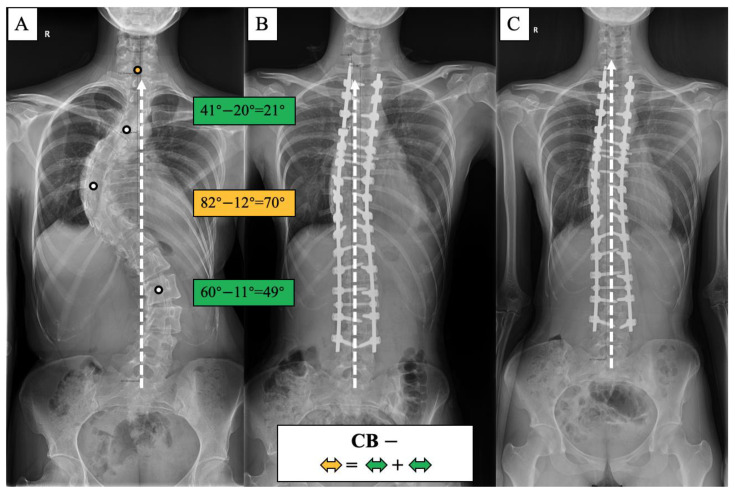 CB− case, 23-year-old female AdIS patient ((A): preoperation, (B): postoperation, and (C): 2-year follow-up). The main thoracic curve was corrected from 82° to 12° (70° correction). The upper thoracic curve was corrected from 41° to 20° (21° correction), and the thoracolumbar curve was corrected from 60° to 11° (49° correction). The correction rate of the main curve matched the compensatory curves, and the coronal plane balance was maintained after surgery and long-term follow-up.