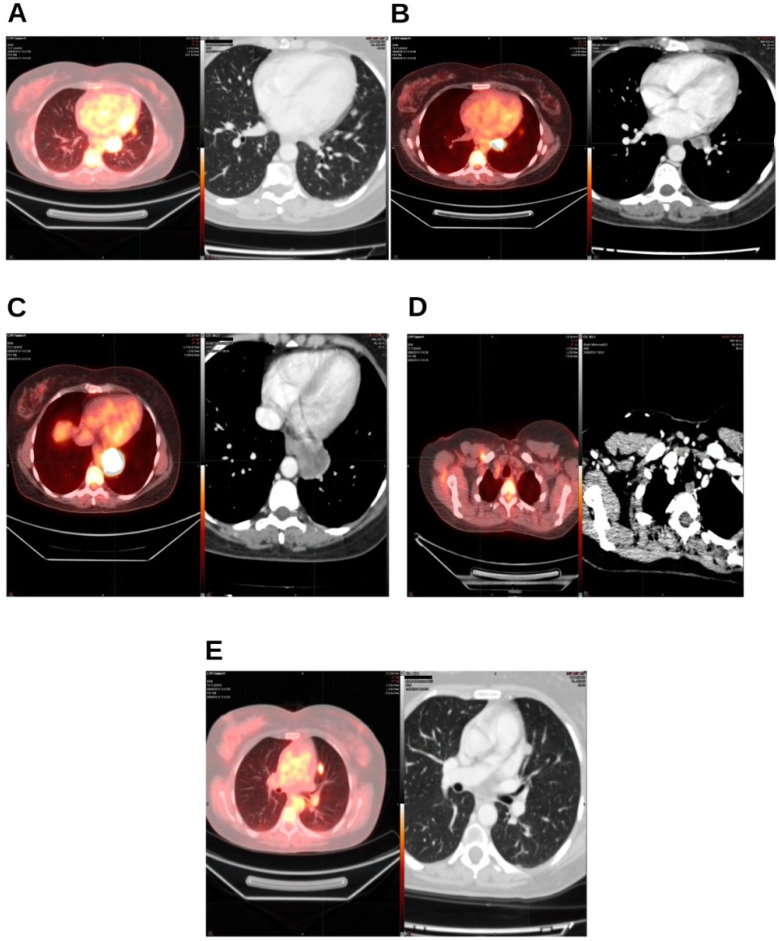 Diagnostic tests before the start of radiotherapy treatment. On the left, the PET-TC from August 2019; on the right, the CT from August 2019. (A) Lingular segment; (B) left hilar lymph node; (C) left paraesophageal nodule; (D) right retropectoral lymph node; (E) nodule in left parascissural segment.