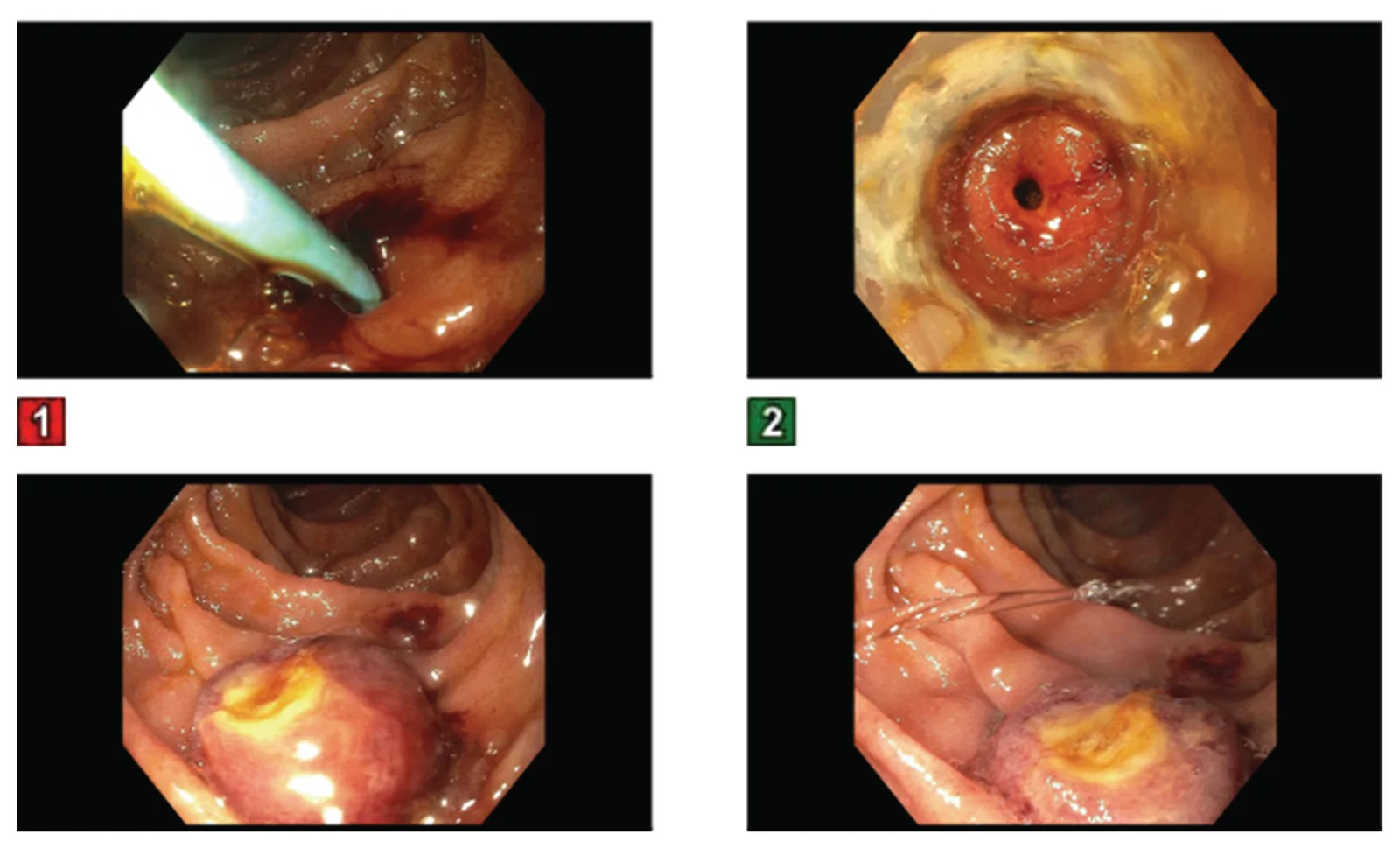 ERCP views demonstrate stent-induced duodenal perforation and subsequent endoscopic closure using an over-the-scope clip (OTSC). The top left panel shows the migrated stent perforating the duodenal wall. The top-right panel shows the perforation site prior to closure. The bottom panels (left and right) show the perforation site after successful endoscopic closure.