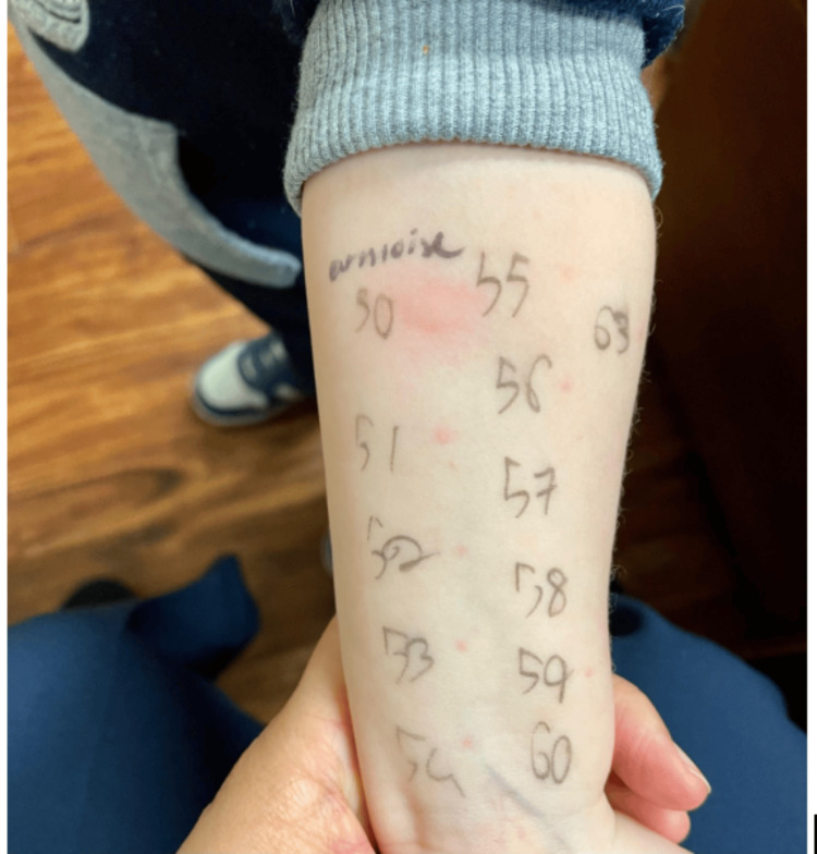 Patient skin test results for peanut, mugwort, and cannabis.