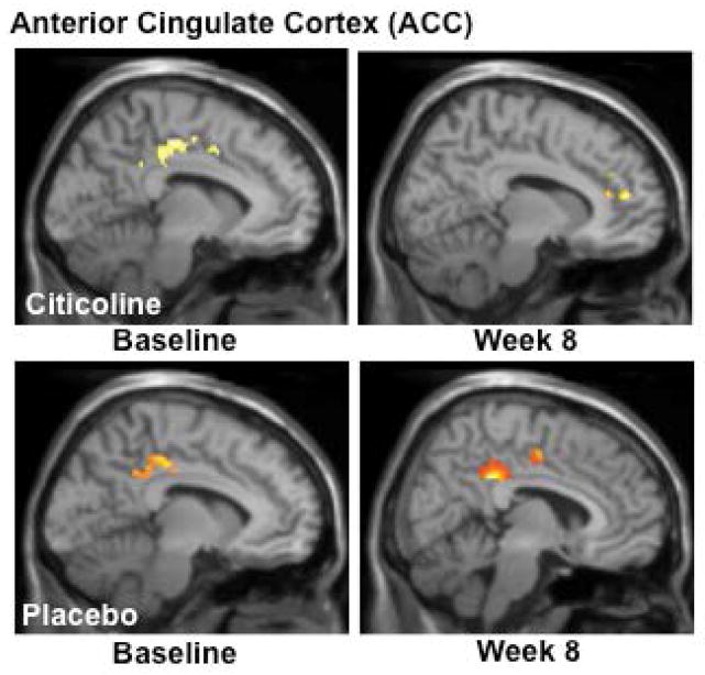 fMRI Analysis of the Stroop Color Word Task: Interference – Color NamingActivation during Stroop (Interference condition minus the Color Naming condition) highlighted a shift from posterior/midcingulate to genual cingulate activation and a corresponding reduction in total voxel cluster size in the citicoline-treated group. The placebo-treated group demonstrated a pattern of posterior ACC activation at baseline which persisted at the 8 week scan, with only minor midcingulate activation and an increase in total voxel cluster size. (k=total cluster size with p < 0.01(uncorrected) and a threshold of ≥ 10 voxels).