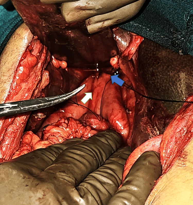 Revision Roux-en-Y hepaticojejunostomy performed over the two tubes described above.White arrow: Roux limb; blue arrow: porta hepatis with neo-hepaticojejunostomy