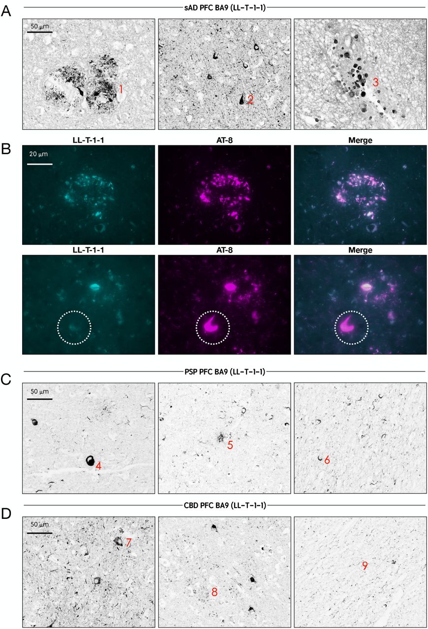 LL-T-1-1 preferentially labels dystrophic neurites in AD and robustly detects classic tau lesions in PSP and CBD brains.(A) High-magnification images of LL-T-1-1 immunostaining in Alzheimer’s disease (AD) brain sections reveal abundant labeling of dystrophic neurites (1), neurofibrillary tangles (2), and corpora amylacea (3) (red labels). (B) High-magnification immunofluorescence images showing LL-T-1-1 (cyan) and AT8 (purple) co-staining. LL-T-1-1 and AT8 co-label dystrophic neurites, while AT8 additionally stains neurofibrillary tangles that are not consistently recognized by LL-T-1-1, as highlighted by the white circle. (C) LL-T-1-1 immunostaining in progressive supranuclear palsy (PSP) brain sections demonstrate robust labeling of globose tangles (4), tufted astrocytes (5), and oligodendroglial coiled bodies (6) (red labels). (D) In corticobasal degeneration (CBD) brain sections, LL-T-1-1 highlights ballooned neurons (7), astrocytic plaques (8), and neuropil threads (9) (red labels).