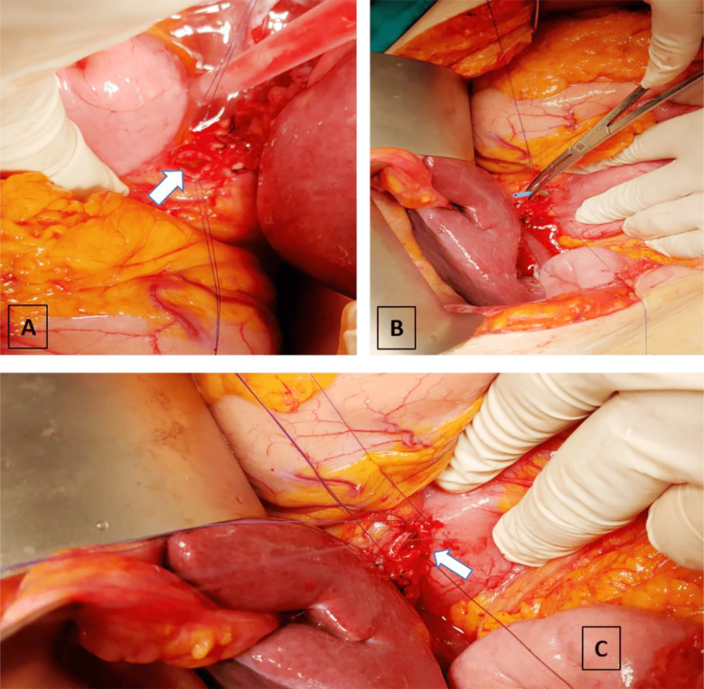 A) Two stay sutures placed on the anterior surface of the common bile duct for traction and choledochotomy was performed B) Stent extraction C) Anterior opening of the side to side choledochoduodenostomy anastomosis.