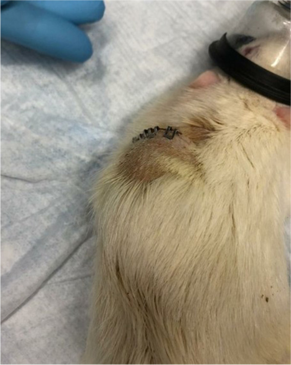 Erythema, inflammation, and fluid accumulation around the pump
