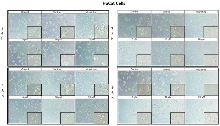 HaCaT cells treated with CBD and controls for 24, 48, 72, and 96 h. Treatments included CBD at concentrations of 5, 10, and 20 μM, 1 μM vincristine, methanol (vehicle), and culture medium (control). Scale bar: 300 μm.
