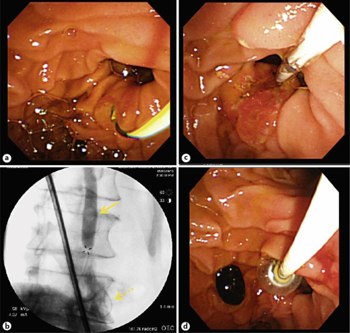 EST during LC. a The guide wire was sent through the contrast tube to the duodenum through the papilla of Vater from the CBD. b X-ray also revealed that the guide wire was sent to the duodenum through the papilla of Vater (dashed arrow) and that there was a defect suggesting a stone (arrow). c The cutting knife was inserted and an intraoperative EST was performed. d Stone removal with a balloon was performed.