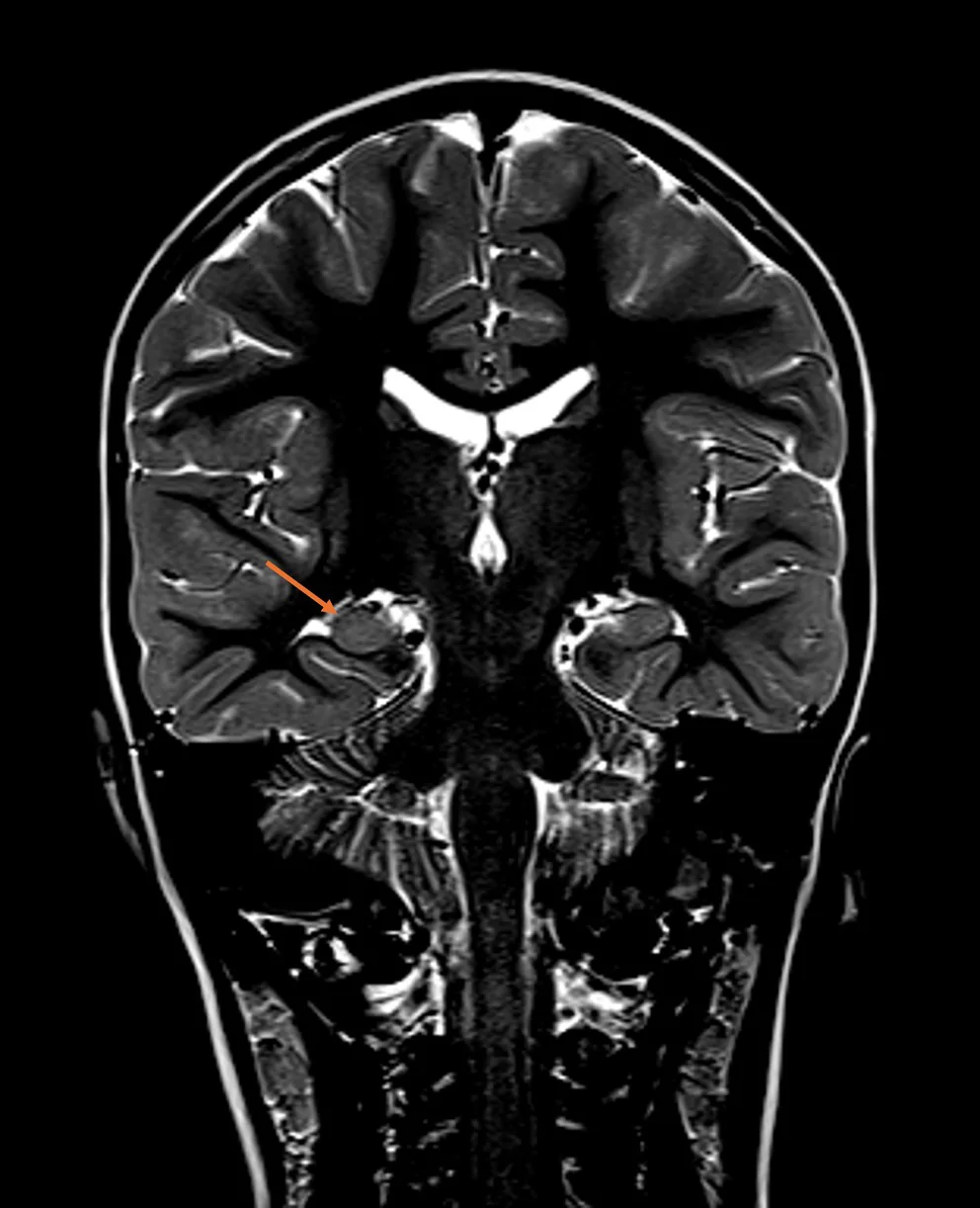 MRI brain. Coronal T2‐weighted brain MRI demonstrating a rounded configuration of the right hippocampus (depicted by arrow) compared with the left, consistent with incomplete hippocampal inversion.