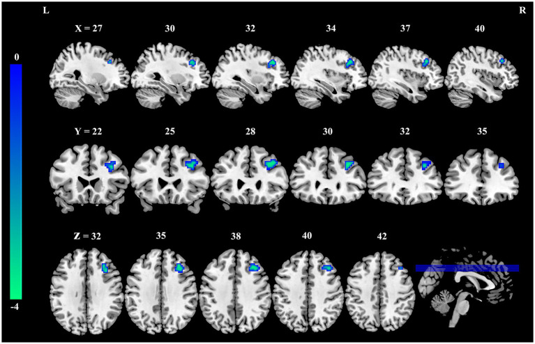 MRI brain scans showing activation areas in blue and green across different views and slices. The views are sagittal, coronal, and axial, labeled with coordinates in X, Y, and Z planes. A color scale indicates intensity levels.