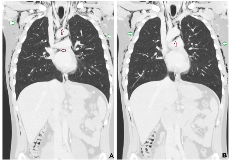 Coronal CT of the thorax demonstrating extensive surgical emphysema within the chest wall and subcutaneous tissues (green arrows).There is also an associated pneumomediastinum, with air outlining the mediastinal structures (red arrows).CT: computed tomography