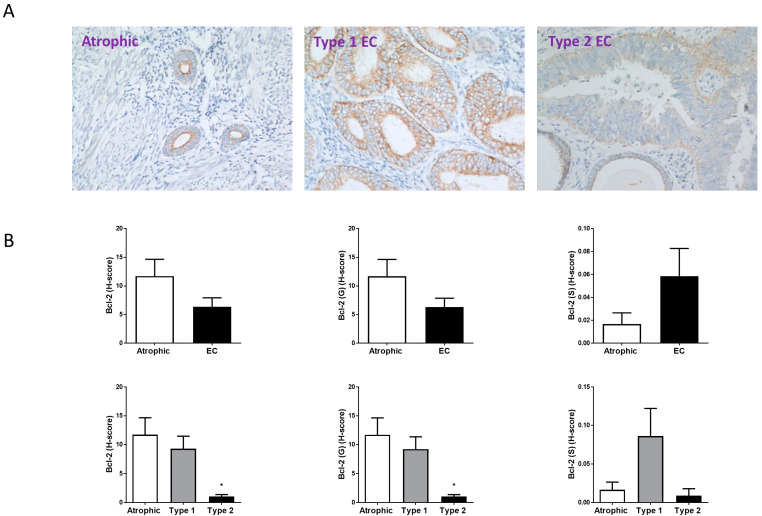 Bcl-2 immunohistochemistry staining patterns. Panel (A) shows brown (DAB) staining for Bcl-2 in representative sections of control (Atrophic), Type 1 and Type 2 endometrial cancer (EC) tissues. Images were captured at 200× magnification. Staining of both stromal and glandular and luminal epithelial tissue is noted in the control tissue, with slightly higher intensity staining of the stromal compartment. By contrast, overall staining levels in the EC tissues were reduced when compared to the control tissue. Panel (B) shows the histomorphometric analyses for the whole tissue, for the glands (G) alone or the stroma (S) alone. The histoscore (H-score) was unaffected in the entire tissue, glands and stroma (top set of graphs) when compared to the atrophic control * p > 0.05; Student’s t-test). Sub-type analysis of the Type 1 and Type 2 EC samples indicated that overall staining H-score levels in Type 2 EC tissues were reduced when compared to the control tissue (lower set of graphs), regardless of whether the entire tissue, glands and stroma when compared to the atrophic control (* p < 0.05; one-way ANOVA with Tukey’s HSD test).