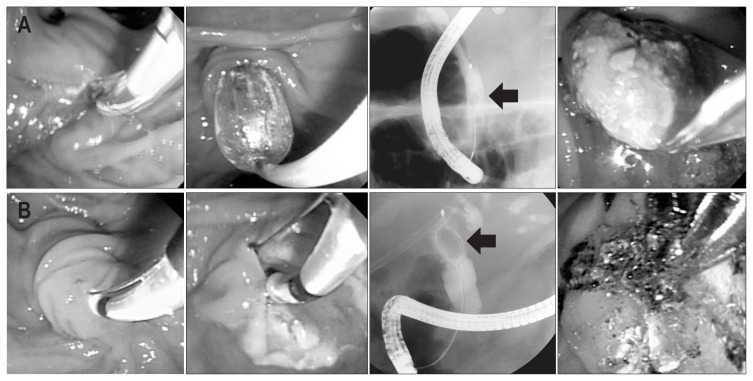 Endoscopic and radiologic views of biliary stone removal by (A) endoscopic papillary large balloon dilation with minor endoscopic sphincterotomy and (B) endoscopic sphincterotomy with mechanical lithotripsy. The arrow indicates common bile duct stones.