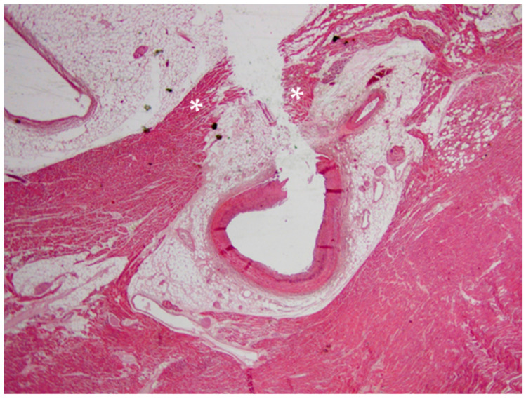 Histopathological image of myocardial bridging: the two parts of the myocardial bridge (disrupted by the coronary dissection) are indicated by white asterisks (Hematoxylin and eosin stain, 10× magnification).