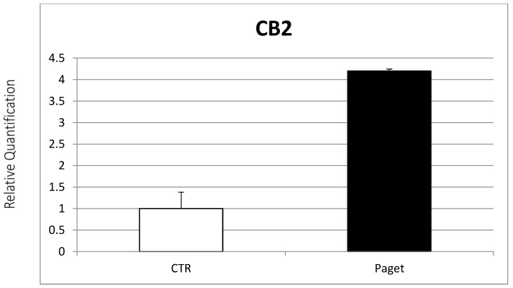 Comparison between CB2 mRNA expression evaluated with RT-PCR from 2 OCs of subjects with PDB and 2 healthy controls. Results were normalized for the housekeeping gene β-Actin and were showed as mean ± SD of three independent experiments on each individual sample.