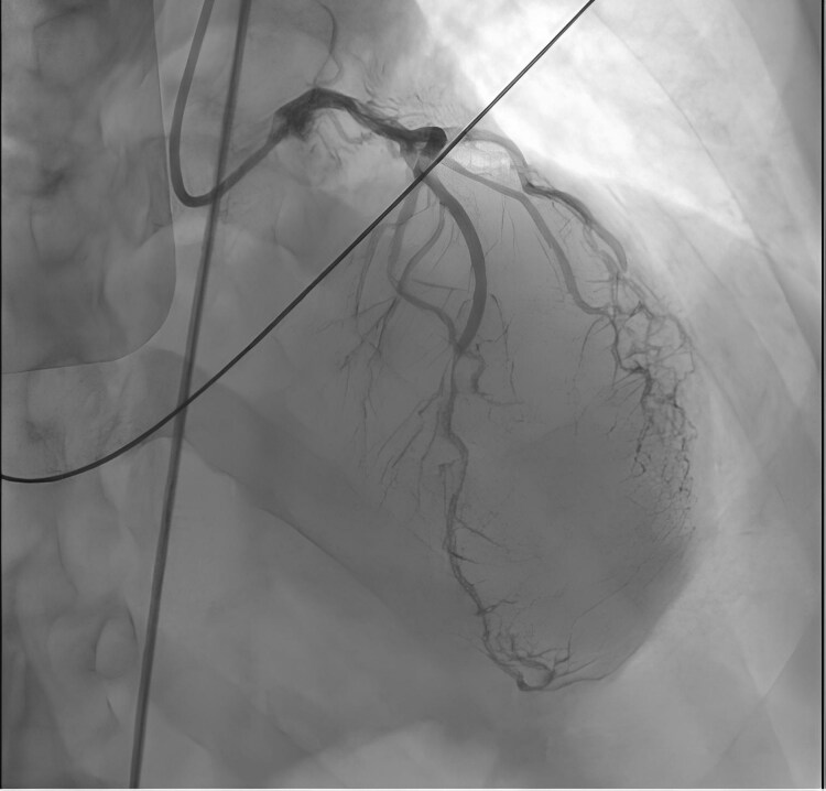 Invasive coronary angiography showing no significant coronary stenoses and demonstrating patent stents with no evidence of restenosis. It also shows a myocardial bridge in the mid-left anterior descending artery.