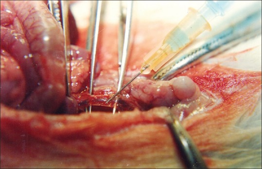 Indocyanine green being injected into the inferior vena cava