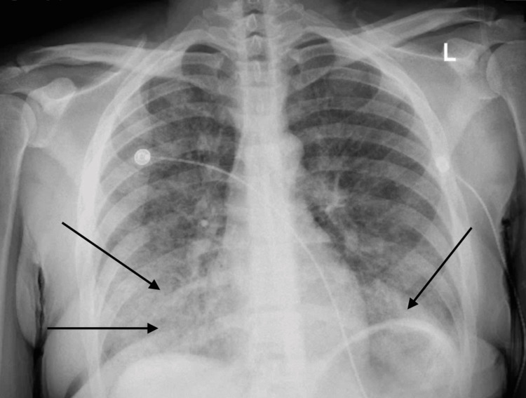 Initial chest X-ray.Black arrows showing bilateral lower lungs infiltrates worse on the right