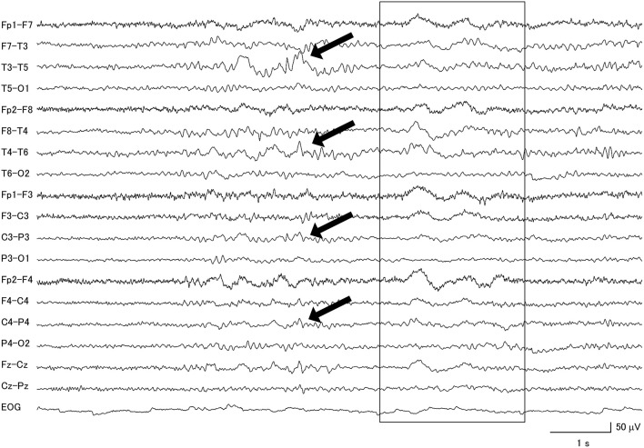 Focal slow wave activities (black arrows) were seen in the frontotemporal regions of a patient with progressive supranuclear palsy, combined with diffuse slow wave activity (within box).