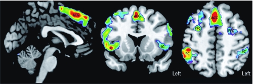 SPM group activation map comparing N‑Back performance with rest for all subjects [painters (n = 27) and controls (n = 27)]. Significant activated clusters (p < 0.001) in the anterior cingulate gyrus (ACG), prefrontal cortex (PFC), IC, and PC are shown using a rainbow color spectrum superimposed on anatomical magnetic resonance images. Significantly activated voxels are colored from purple (p = 0.001) to red (variable depending on location, but at least p < 0.001).