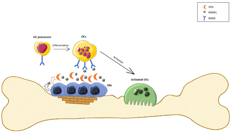 Bone remodeling process. OBs express RANK-L which promotes osteoclastogenesis following its binding with specific receptor RANK onto the OCs precursors’ surface. This binding induces the maturation of preosteoclasts into mature OCs, resulting in resorption of bone tissue and the release of growth factors. OBs also produce osteoprotegerin (OPG), which acts as a decoy receptor for RANK-L, inhibiting OC formation by blocking RANK-L binding to RANK and stimulating OCs to induce apoptosis. The OPG/RANK-L ratio is a better indicator of bone remodeling status: a high ratio represents bone formation, while a low ratio favors bone resorption.