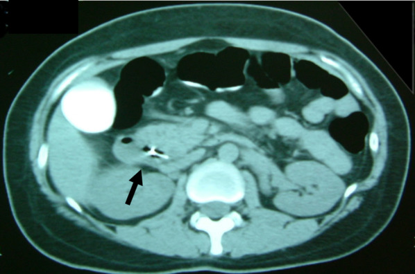 Abdominal CT. A computed tomography (CT) scan showing the burst balloon located at the site of the biliary sphincter. The arrow indicates the burst balloon of the EBD catheter at the site of the biliary sphincter