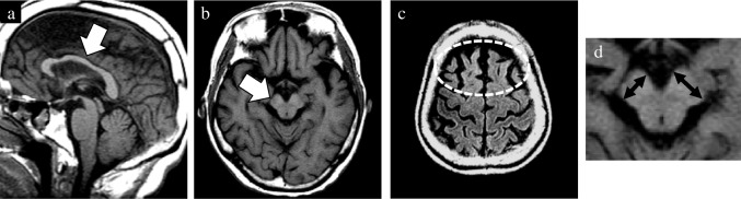 A representative case of radiologically typical CBD. This 69-year-old female patient obtained an antemortem clinical diagnosis of AD. After the postmortem pathological examination, it was proved that main pathology of this patient was CBD. MRI was performed one year after the symptom onset. In contrast to mild atrophy of the callosal body (arrow, a), sagittal T1WI showed relatively preserved midbrain. Axial T1WI and FLAIR image showed right dominant asymmetric atrophy of the cerebral peduncle and frontal lobe (arrow, b). Additionally, mild SWMH was detected in the frontal lobe at high convexity (circle, c). A magnified view was exhibited to emphasize the asymmetry of the short axis in the cerebral peduncles (double sided arrows, d). a, sagittal T1WI; b, axial T1WI; c, axial FLAIR image; AD, Alzheimer’s disease; CBD, corticobasal degeneration; FLAIR, fluid-attenuated inversion recovery; SWMH, subcortical white matter hyperintensity; T1WI, T1-weighted image