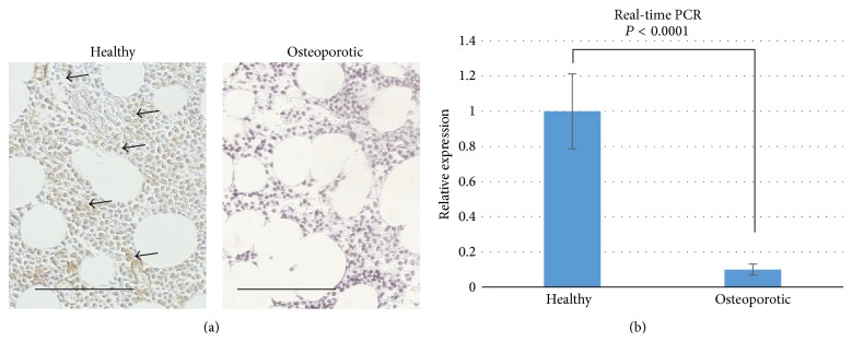 Expression of cannabinoid receptor 2 in healthy and osteoporotic patients. (a) Immunohistochemistry shows presence of CB2 receptor in the bone marrow tissue of healthy donor, and absence in osteoporotic patients. Bar = 100 μm. Arrowheads indicate the positively stained cells. (b) Real-time PCR analysis of CNR2 bone morrow tissue of healthy donor and osteoporotic donor (N = 4).