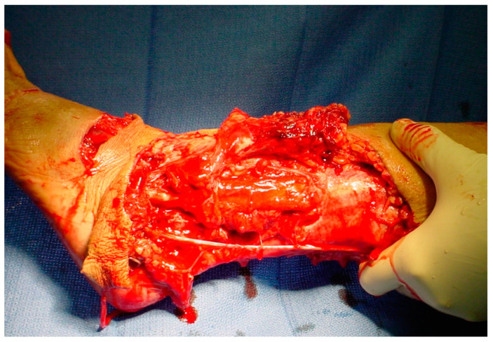 An avulsion, degloving wound of the lateral, distal left lower extremity with extensive destruction of the soft tissue.