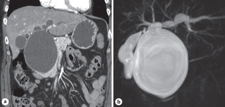 Preoperative image. a CT showed a marked cystic dilation of the entire common bile duct (maximum diameter: 81.5 mm) and an intrahepatic bile duct dilated near the hilum. b Magnetic resonance cholangiopancreatography showed dilation of the common bile duct and intrahepatic bile duct. Pancreatobiliary maljunction (bile duct type) was also observed, diagnosed as Todani classification type IV-A.