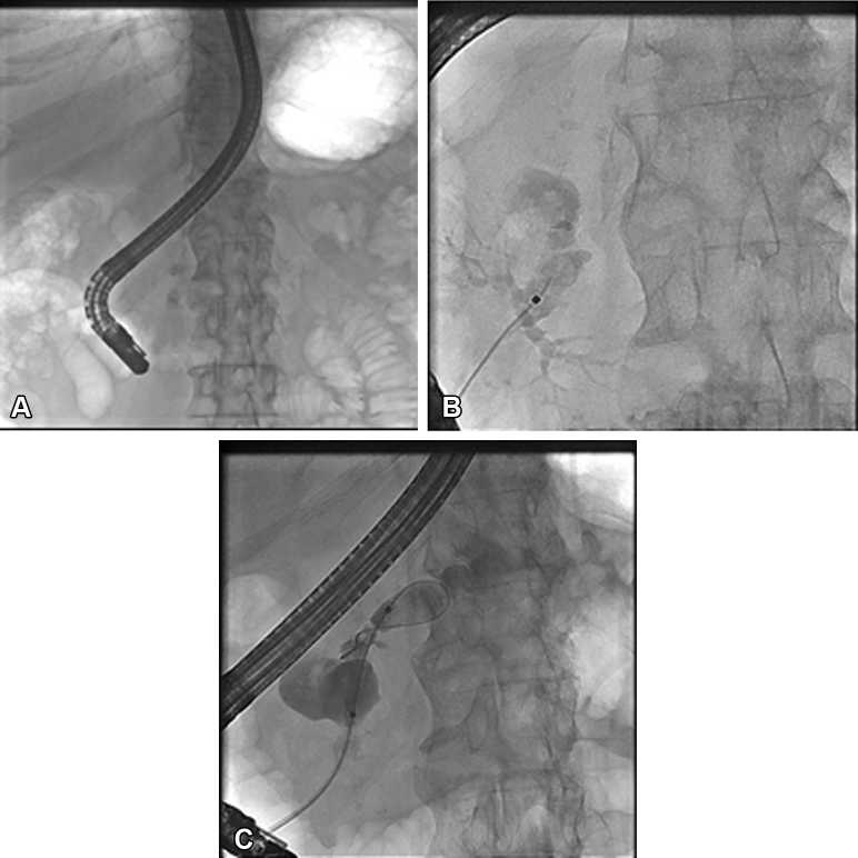 A, B, andC: Fluoroscopic images demonstrating a duct stricture in the pancreatic head with intra-ductal calculi and the pseudocyst.