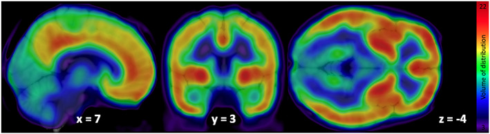 Mean volume of distribution of F18‐FMPEP‐d2 PET scans from 36 subjects.