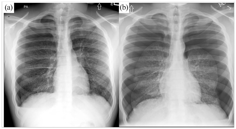 (a) Chest radiograph showing large right pneumothorax. (b) Chest radiograph showing recurrent large right pneumothorax and new left pneumothorax 1 week later.