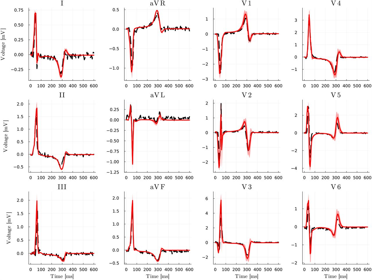 Inverse uncertainty quantification: matching clinical data. Clinical recordings (dashed, black) and mean estimation (red, solid) of 12-lead ECGs for the HLHS pediatric patient via HMC. Light red encompasses the variability between mean minus/plus five standard deviations.