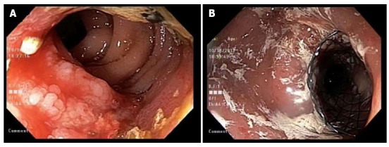 Esophagogastroduodenoscopy findings 15 mo after initial endoscopic retrograde cholangiopancreatography. A: Duodenal mass visualized encroaching in the lumen of 2nd portion of duodenum; B: SEMS placed over the area of the encroaching mass in the 2nd portion of the duodenum. SEMS: Self expanding metal stent.